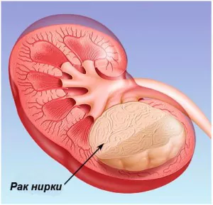 Рак нирки