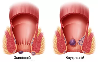 Види геморою