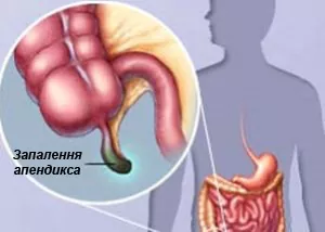 Запалення апендикса