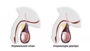 Порівняння нормального стану та стриктури уретри