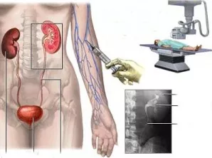 Урографія як метод діагностики сечокам'яної хвороби
