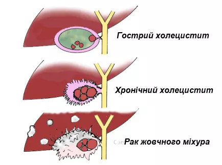 Процес розвитку хвороби