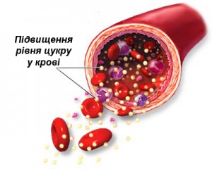 Підвищення рівня цукру у крові при цукровому діабеті