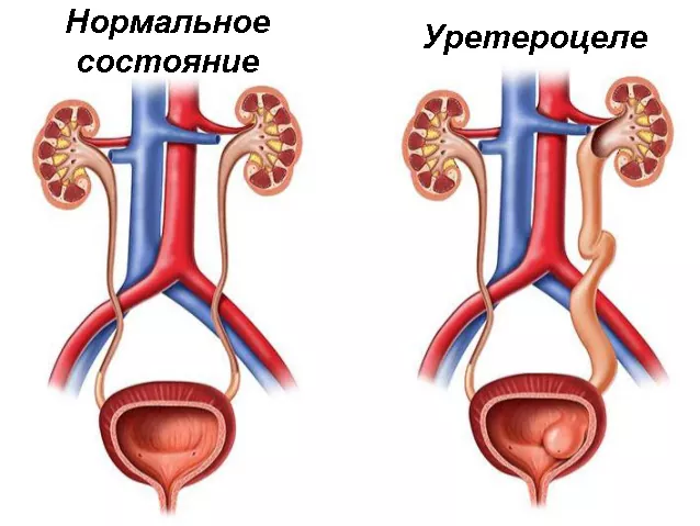 Сравнение нормального состояния мочевода и уретероцеле