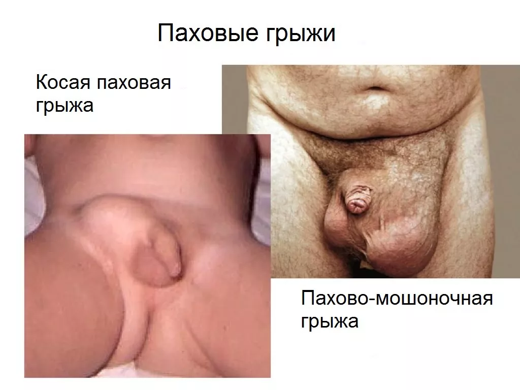 Варианты паховых грыж