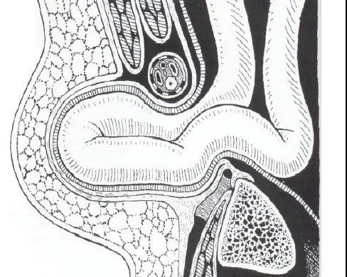 Прямая паховая грыжа