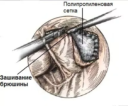 Этап ушивания брюшины