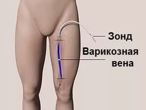 Операції з видалення варикозу
