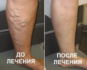 Варикозне розширення вен нижніх кінцівок до і після