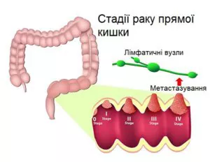 Стадії раку прямої кишки