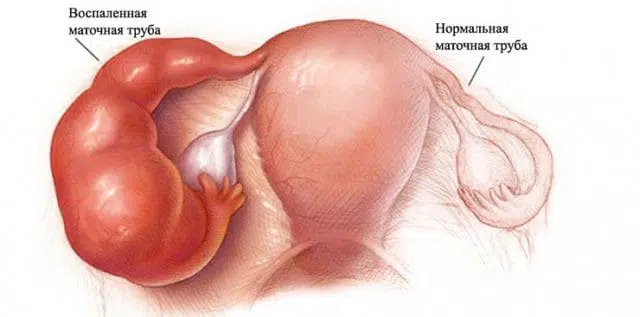 Гідросальпінкс