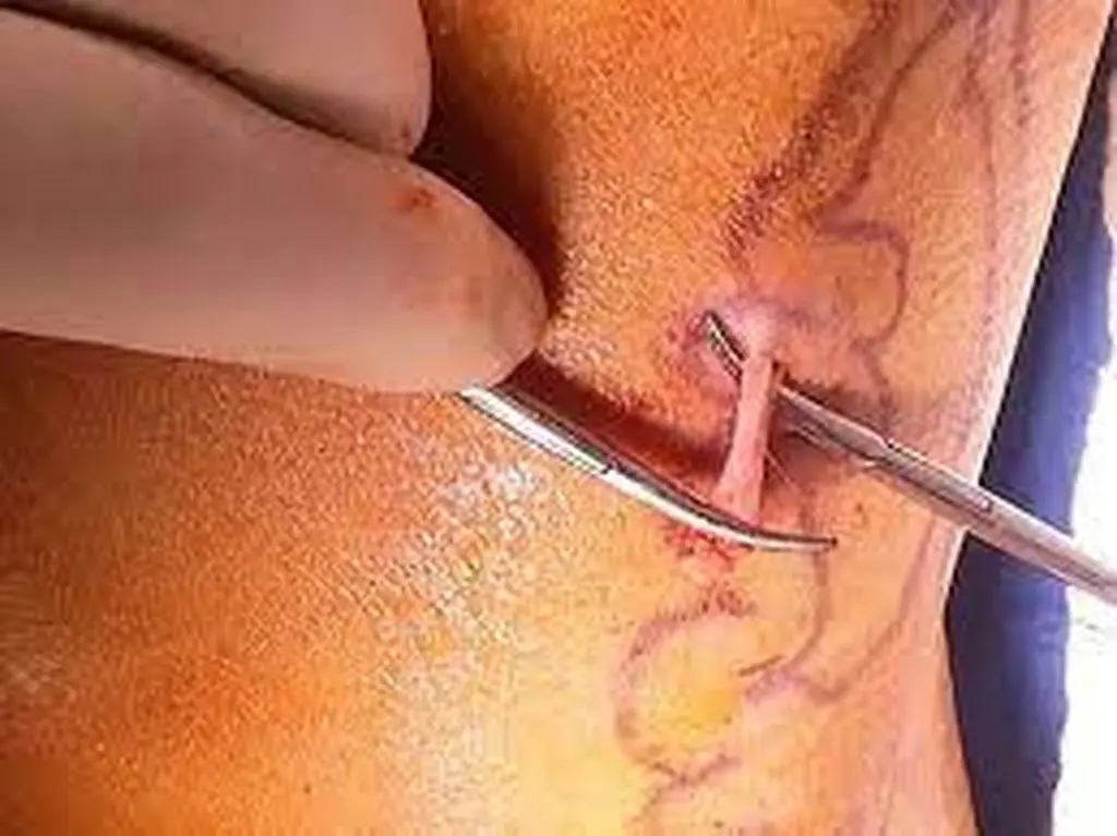 Клініка Біляка Мініфлебектомія фото 3