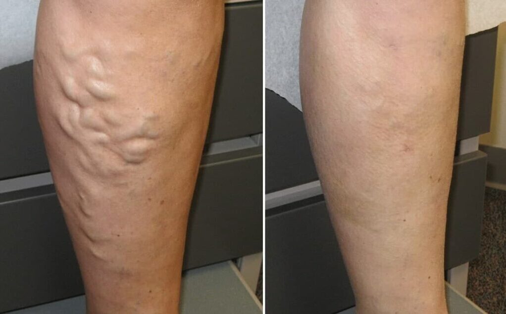 Варикозне розширення вен нижніх кінцівок до і після