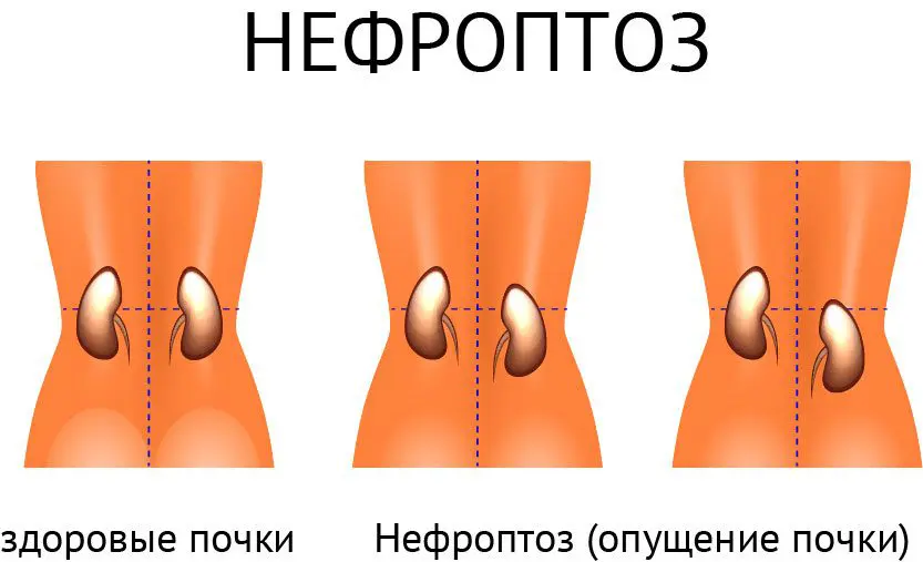 Операция на почках: как выбрать квалифицированного хирурга и подготовиться к лапароскопической нефропексии фото Операция на почках: как выбрать квалифицированного хирурга и подготовиться к лапароскопической нефропексии фото