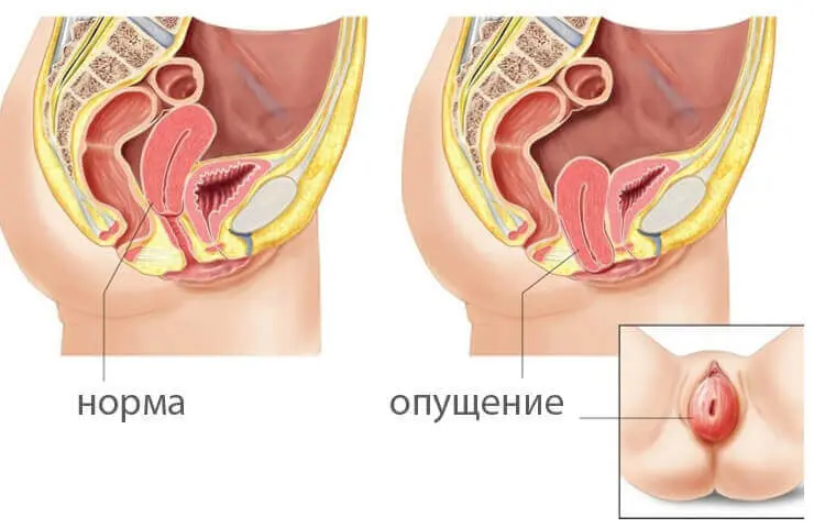 Опущение матки – лапароскопическая сакрокольпопексия как эффективное решение фото