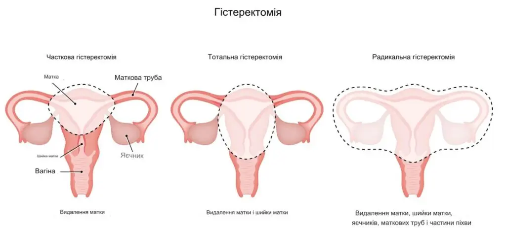 Гістеректомія лапароскопічним методом: сучасний підхід до видалення матки фото