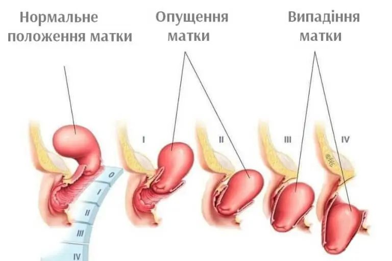 Сакрокольпопексія — лапароскопічна операція при випадінні матки фото
