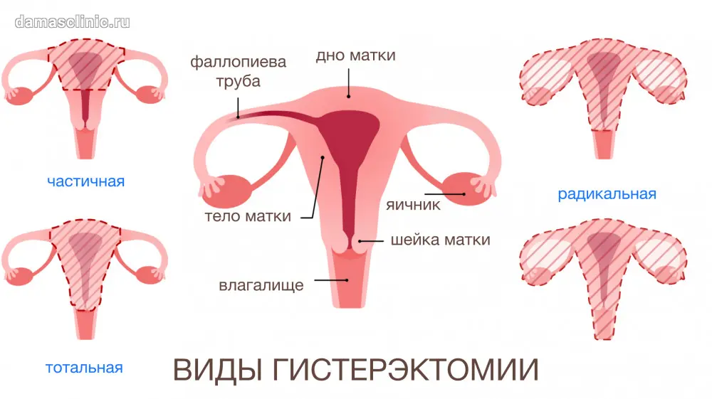 Гистерэктомия лапароскопическим методом: современный подход к удалению матки фото