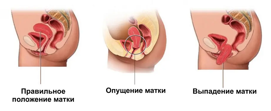 Что такое выпадение матки и как его лечить фото