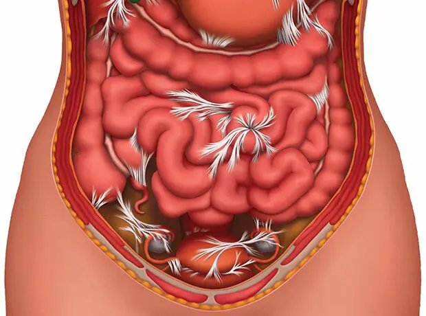 Клініка Біляка Що таке спайковий процес черевної порожнини і чому він виникає фото 1