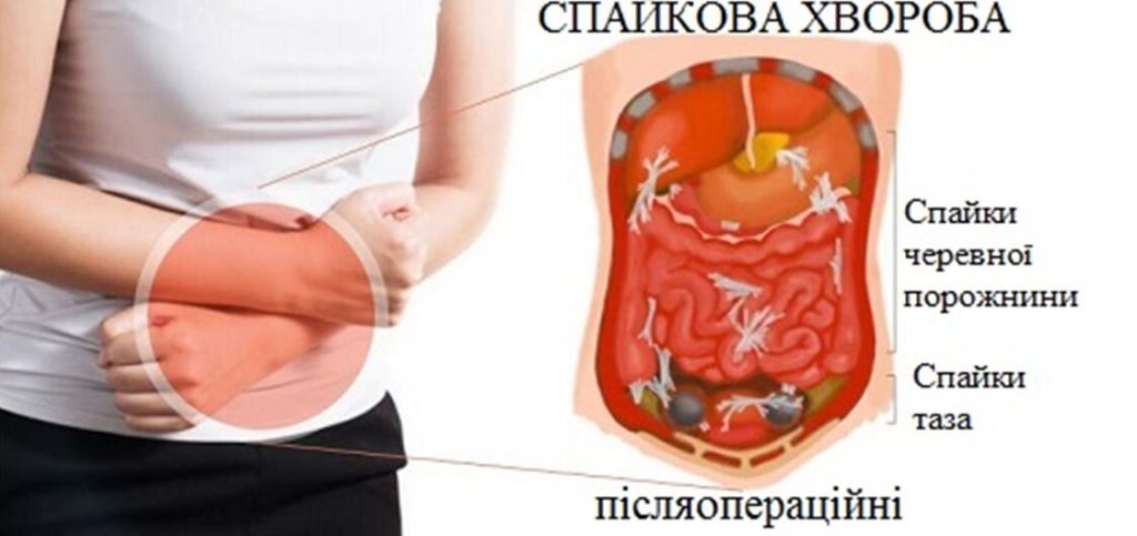 Клініка Біляка Що таке спайковий процес черевної порожнини і чому він виникає фото 5