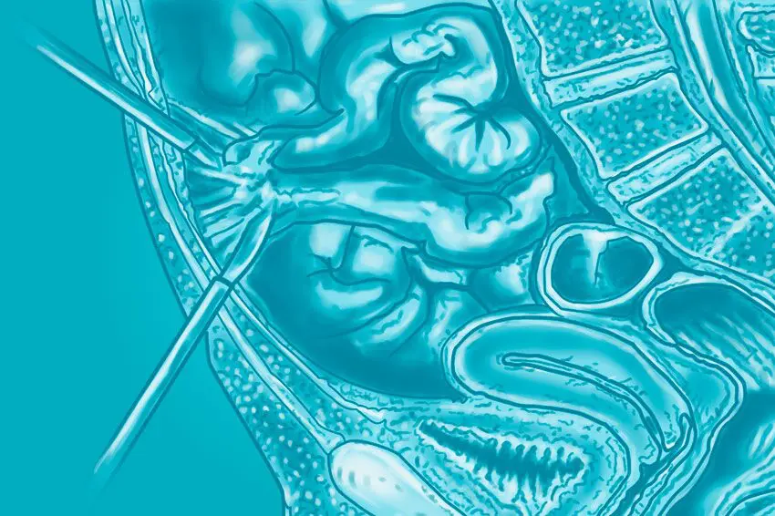 Клініка Біляка Що таке спайковий процес черевної порожнини і чому він виникає фото 9