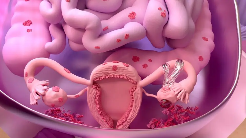 Клініка Біляка Що таке спайковий процес черевної порожнини і чому він виникає фото 3