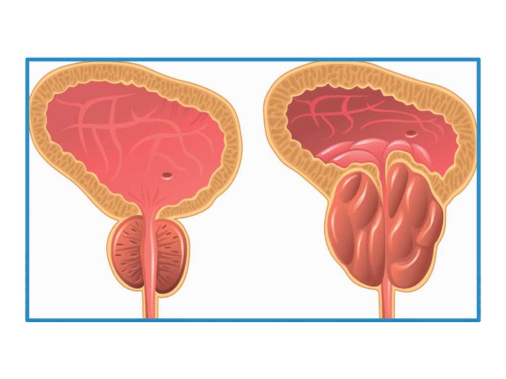 Клініка Біляка Міфи про рак простати: що правда, а що вигадка? фото 2 Клініка Біляка Міфи про рак простати: що правда, а що вигадка? фото 1