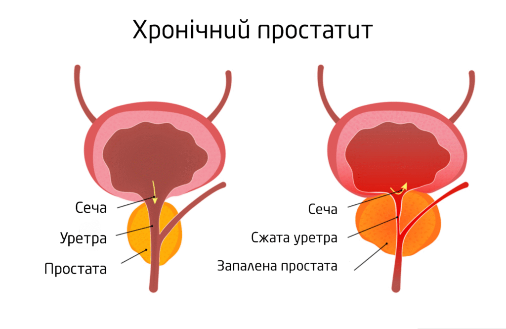 Клініка Біляка Хронічний простатит: як розпізнати та лікувати сучасними методами фото 1