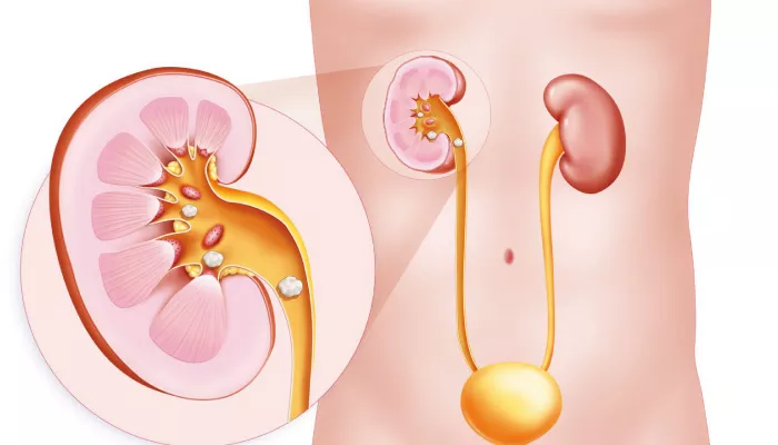 Клініка Біляка Що таке сечокам’яна хвороба у молодих людей і як її попередити фото 2 Клініка Біляка Що таке сечокам’яна хвороба у молодих людей і як її попередити фото 1
