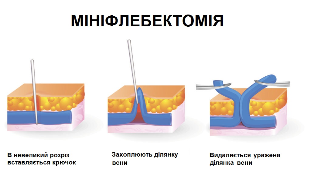 Судинні зірочки й варикоз: як відрізнити та що ефективніше - склеротерапія, ЕВЛК чи мініфлебектомія фото Судинні зірочки й варикоз: як відрізнити та що ефективніше - склеротерапія, ЕВЛК чи мініфлебектомія фото