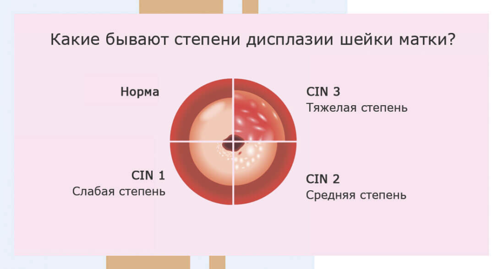 Дисплазия шейки матки CIN1–CIN3: когда достаточно наблюдения, а когда требуется LEEP/конизация фото