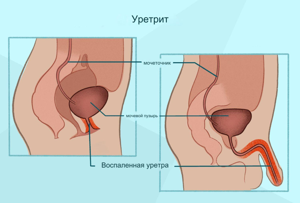 Уретрит у мужчин и женщин: симптомы, причины и методы лечения фото